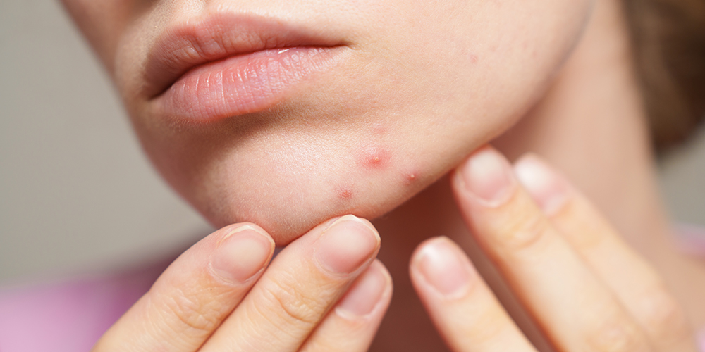 Onzuivere huid / Vette huid / Gemengde huid / Acne