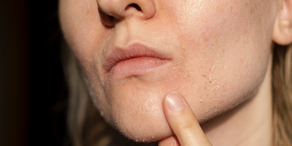 Droge en trekkerige huid / Vochtarm