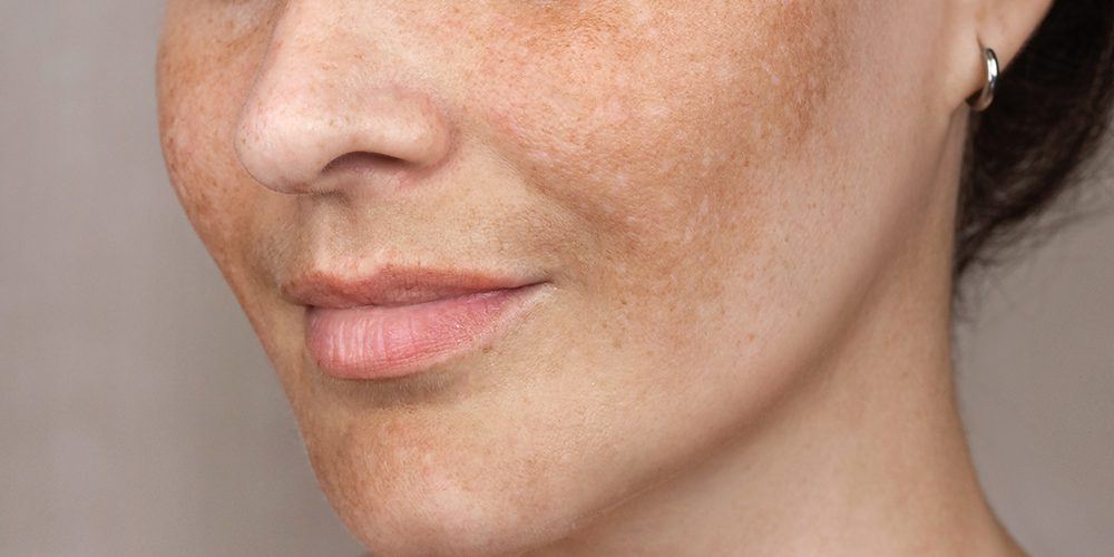 Pigmentatie, vermoeide huid, doffe uitstraling